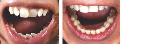 Harmonieschiene Teltow, Berlin | Zahnarztpraxis Engel Harmonieschiene Teltow, Berlin | Zahnarztpraxis Engel